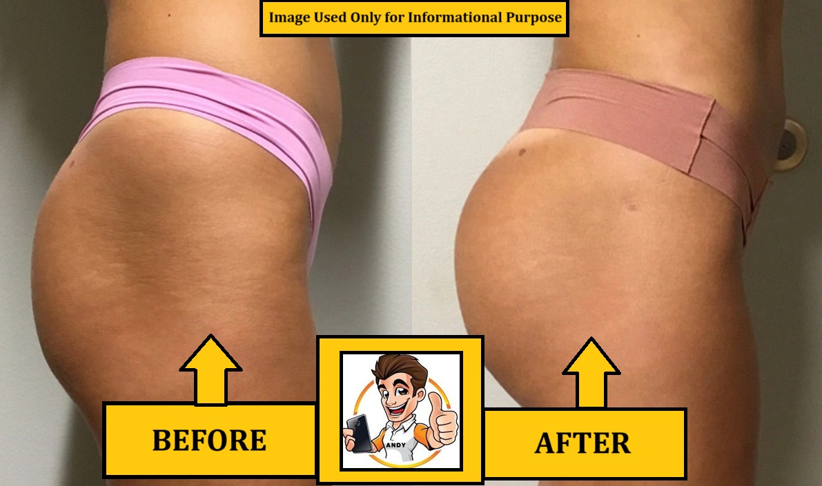 Brazilian Butt Lift Brazilian Butt Lift